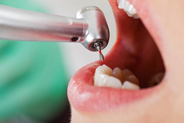 Best Emergency Tooth Extraction in Hanover, IN